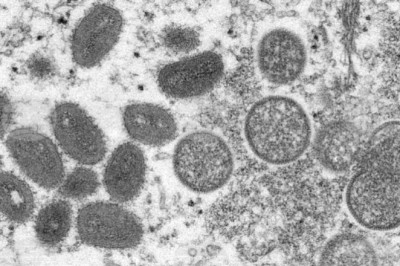 Първи случаи на маймунска шарка в България. Какво ще предприемете?