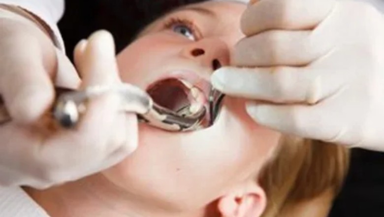 Teeth Extractions NYC