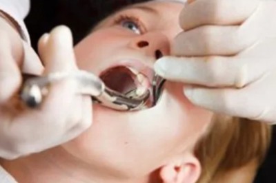 Teeth Extractions NYC