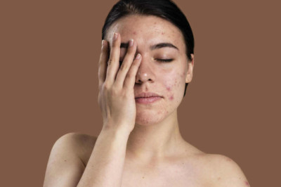 Има ли спасение от акнето или всичко е ген